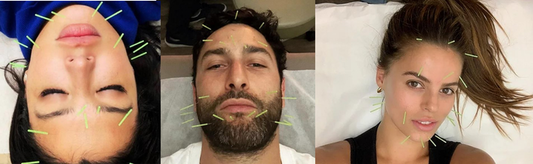 Back by Popular Demand: Aesthetic Acupuncture Made Simple!