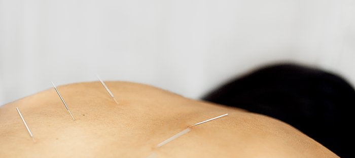 Student Acupuncture Clinic Open This Week